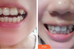 成都拜博拜爾口腔醫(yī)院周福生整形價格表附牙綜合案例展示