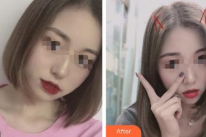 成都悅麗美科李德敏醫(yī)生整形價格表附抗衰老案例展示