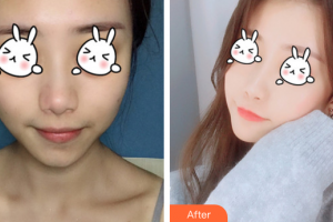 廣州海峽醫(yī)學(xué)整形美容醫(yī)院廖奇峰整形價(jià)格表附光子嫩膚案例展示