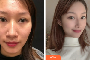 廣州紫馨美容醫(yī)院劉晉艷整形價(jià)格表附微針祛痘案例展示