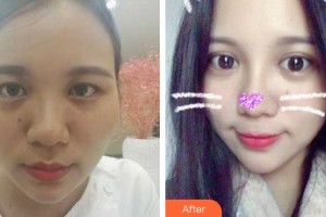 成都臻愛唯美醫(yī)療美容醫(yī)院葉飛輪整形價格表附美眼翹鼻套餐案例展示