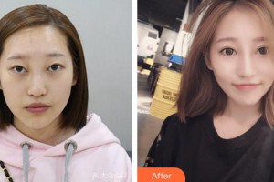 成都西區(qū)醫(yī)院醫(yī)學美容科鄧東偉整形價格表附埋線雙眼皮+鼻部手術案例展示