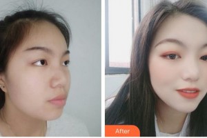 成都科思研醫(yī)療美容診所趙澤方整形價格表附補水保濕案例展示