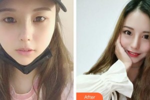 成都格萊麗醫(yī)療美容門診部石峰整形價格表附切開雙眼皮案例展示