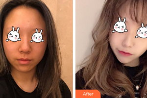 廣州紫馨美容醫(yī)院百束比古整形價(jià)格表附光子嫩膚案例展示