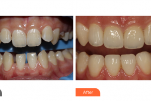 廣州晨曦醫(yī)療美容醫(yī)院李霽林整形價(jià)格表附牙齒矯正案例展示