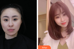 廣州海峽醫(yī)學(xué)整形美容醫(yī)院雷浚嶸整形價(jià)格表附膠原蛋白除皺案例展示