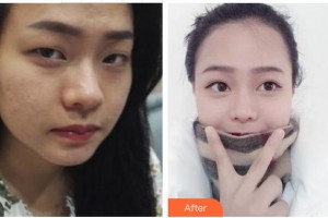 成都忠愛醫(yī)療美容診所王瑩瑩整形價格表附眼部綜合案例展示