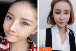 成都潤禾皮膚病?？漆t(yī)院殷明坤整形價(jià)格表附祛斑案例展示