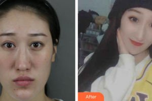 廣州海峽醫(yī)學(xué)整形美容醫(yī)院呂方中整形價(jià)格表附雙顎畸形矯正術(shù)案例展示