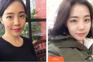 成都潤禾皮膚病?？漆t(yī)院李艷整形價(jià)格表附祛痘美膚案例展示