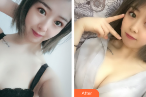 廣州洛萱醫(yī)療美容門診部周紹龍整形價(jià)格表附自體脂肪隆胸案例展示