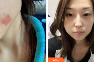 廣州軍區(qū)武漢總醫(yī)院醫(yī)學(xué)整形美容中心桂思整形價(jià)格表附點(diǎn)陣激光案例展示