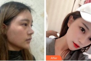 成都安莎貝拉醫(yī)療美容門診部周順波整形價(jià)格表附鼻部綜合案例展示