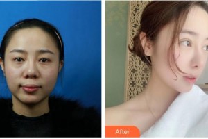 成都安莎貝拉醫(yī)療美容門診部文惠英整形價(jià)格表附鼻部綜合案例展示