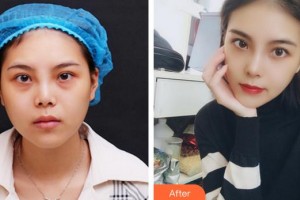 成都臻愛唯美醫(yī)療美容醫(yī)院王皓民整形價(jià)格表附隆鼻案例展示