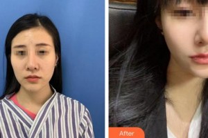 成都晶都醫(yī)療美容醫(yī)院林鴻祥整形價(jià)格表附多方面部埋線提升案例展示