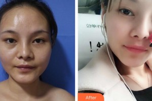 成都綠葉愛麗美婦產(chǎn)科醫(yī)院醫(yī)療美容科何鵬整形價(jià)格表附自體脂肪填充案例展示