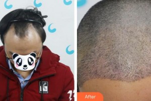 成都絲緣毛發(fā)醫(yī)療美容門診部陳戰(zhàn)兵整形價(jià)格表附植發(fā)案例展示