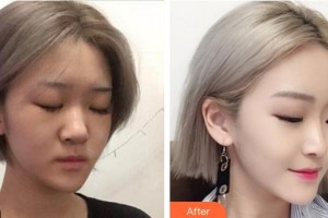 成都暄妍醫(yī)療美容門診部潘寧整形價(jià)格表附鼻部手術(shù)整形案例展示