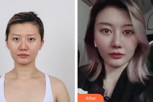 成都友誼醫(yī)院李萍整形價(jià)格表附鼻部手術(shù)案例展示