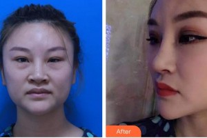 成都友誼醫(yī)院柏雨青整形價(jià)格表附鼻部綜合案例展示