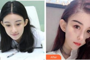 成都瑞麗詩美學(xué)植發(fā)門診部姜印整形價(jià)格表附發(fā)際線案例展示