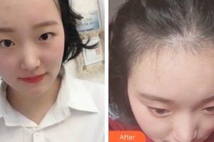 成都絲緣毛發(fā)醫(yī)療美容門診部陳祖慶整形價(jià)格表附植發(fā)案例展示