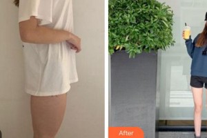 成都怡脂醫(yī)療美容醫(yī)院鄧萌整形價(jià)格表附大腿吸脂案例展示