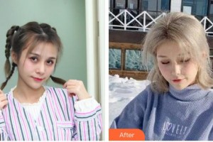 成都瑞麗詩美學(xué)植發(fā)門診部尚俊整形價(jià)格表附發(fā)際線案例展示