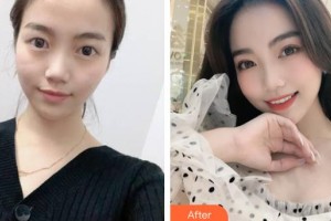 成都愛迪眼科醫(yī)院張鳴整形價(jià)格表附全切雙眼皮案例展示