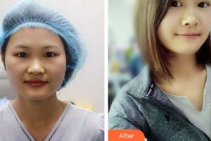 成都愛迪眼科醫(yī)院胡玉章整形價(jià)格表附眼部綜合案例展示