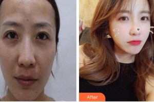 成都中醫(yī)藥大學(xué)附屬醫(yī)院銀海醫(yī)美何軍整形價(jià)格表附脂肪填充案例展示