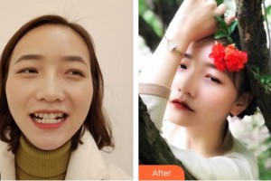 成都茁悅口腔診所童心整形價(jià)格表附牙齒矯正案例展示