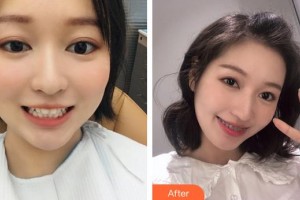 成都茁悅口腔診所陳偉民整形價(jià)格表附牙齒矯正案例展示