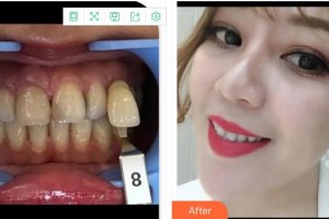 成都茁悅口腔診所羅鴻思整形價(jià)格表附牙齒美白案例展示