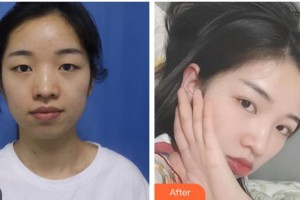 成都愛爾眼科醫(yī)院樊映川整形價(jià)格表附眼部綜合案例展示