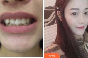 成都茁悅口腔診所鞏健整形價(jià)格表附牙綜合案例展示