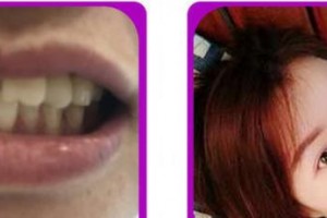 成都茁悅口腔診所胡永整形價(jià)格表附牙齒矯正案例展示