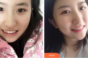 成都茁悅口腔診所張瑞澤整形價(jià)格表附牙綜合案例展示