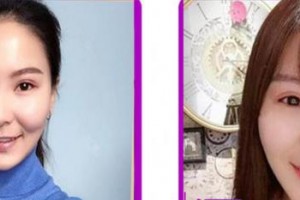 成都茁悅口腔診所劉恒整形價(jià)格表附牙齒隱形矯正案例展示