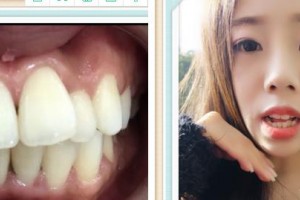 成都康橋眼科醫(yī)院雷仲其整形價(jià)格表附牙齒矯正案例展示