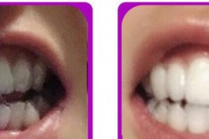 成都康橋眼科醫(yī)院巫雷整形價(jià)格表附牙齒矯正案例展示