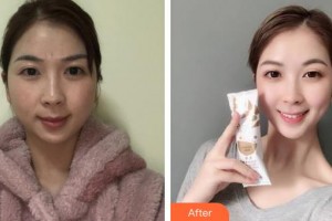 成都愛迪眼科醫(yī)院劉誼整形價(jià)格表附牙齒矯正案例展示