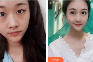 成都愛迪眼科醫(yī)院連浩整形價(jià)格表附眼部綜合案例展示