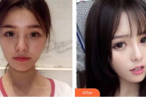 成都愛迪眼科醫(yī)院曾慶華整形價(jià)格表附眼部綜合案例展示