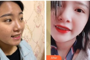 成都茁悅口腔診所馮李娟整形價(jià)格表附牙齒矯正案例展示