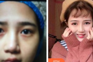 成都愛迪眼科醫(yī)院劉華整形價(jià)格表附眼部整形案例展示