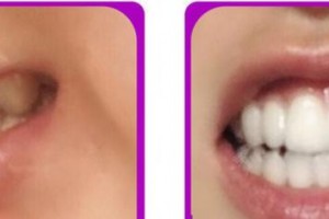 成都茁悅口腔診所楊瑾廷整形價格表附牙齒矯正案例展示