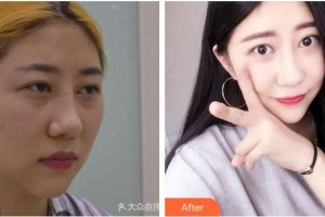 成都愛迪眼科醫(yī)院李綱整形價格表附雙眼皮案例展示